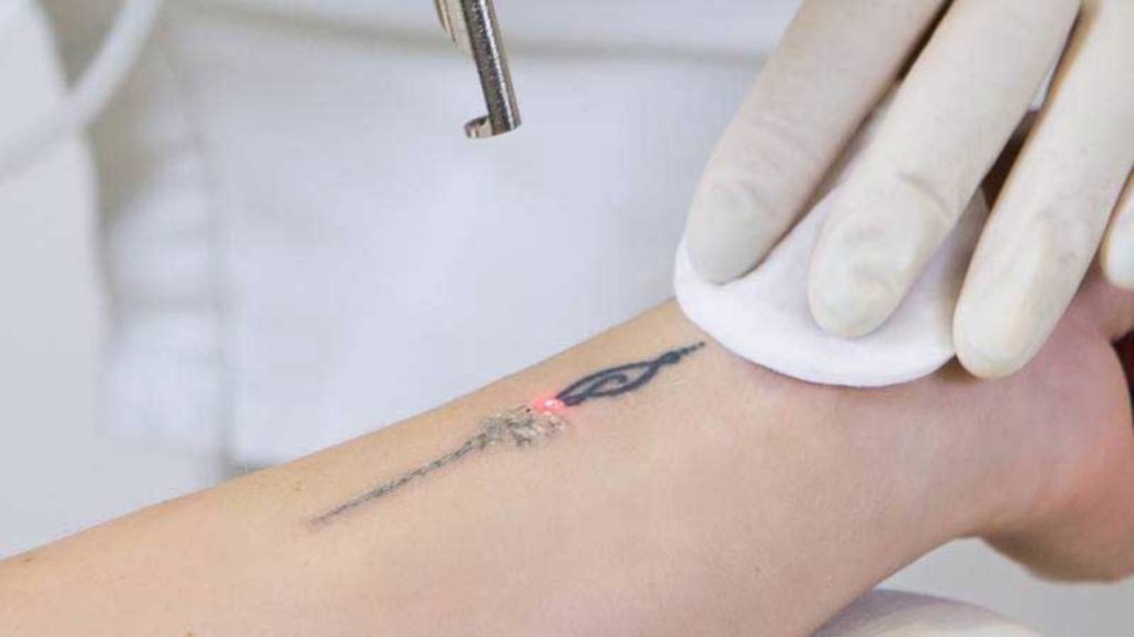 tattoo removal central coast